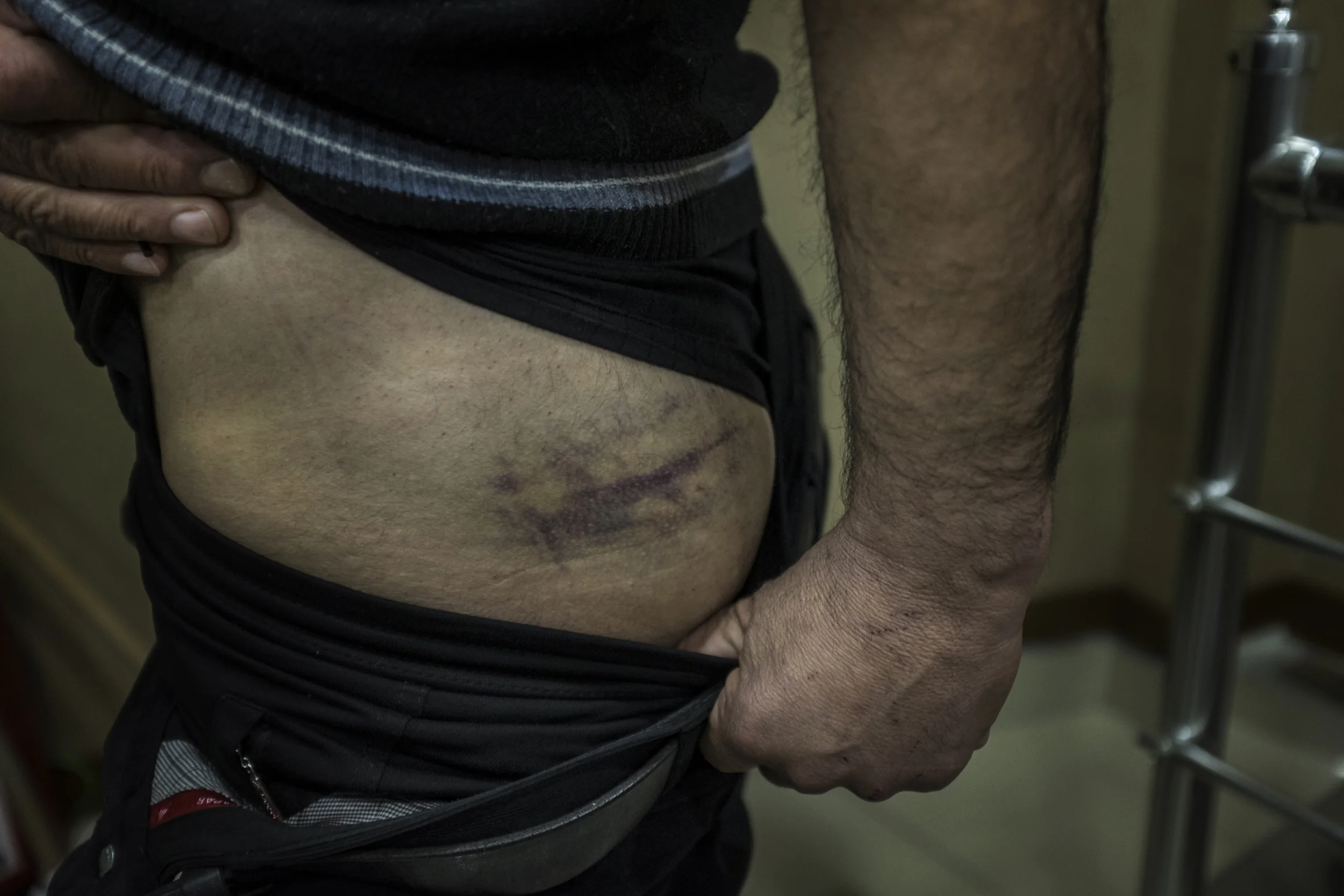 Ferhad shows bruises he says were inflicted by Bulgarian border police when he tried to cross the border.