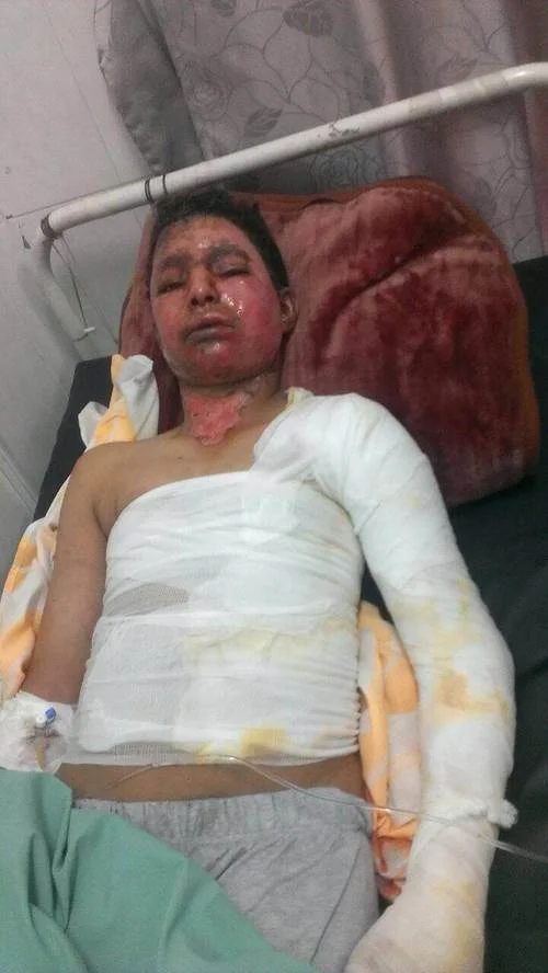 أصيب عبد الله صالح الجحافي البالغ من العمر 16 عاماً بحروق مروعة