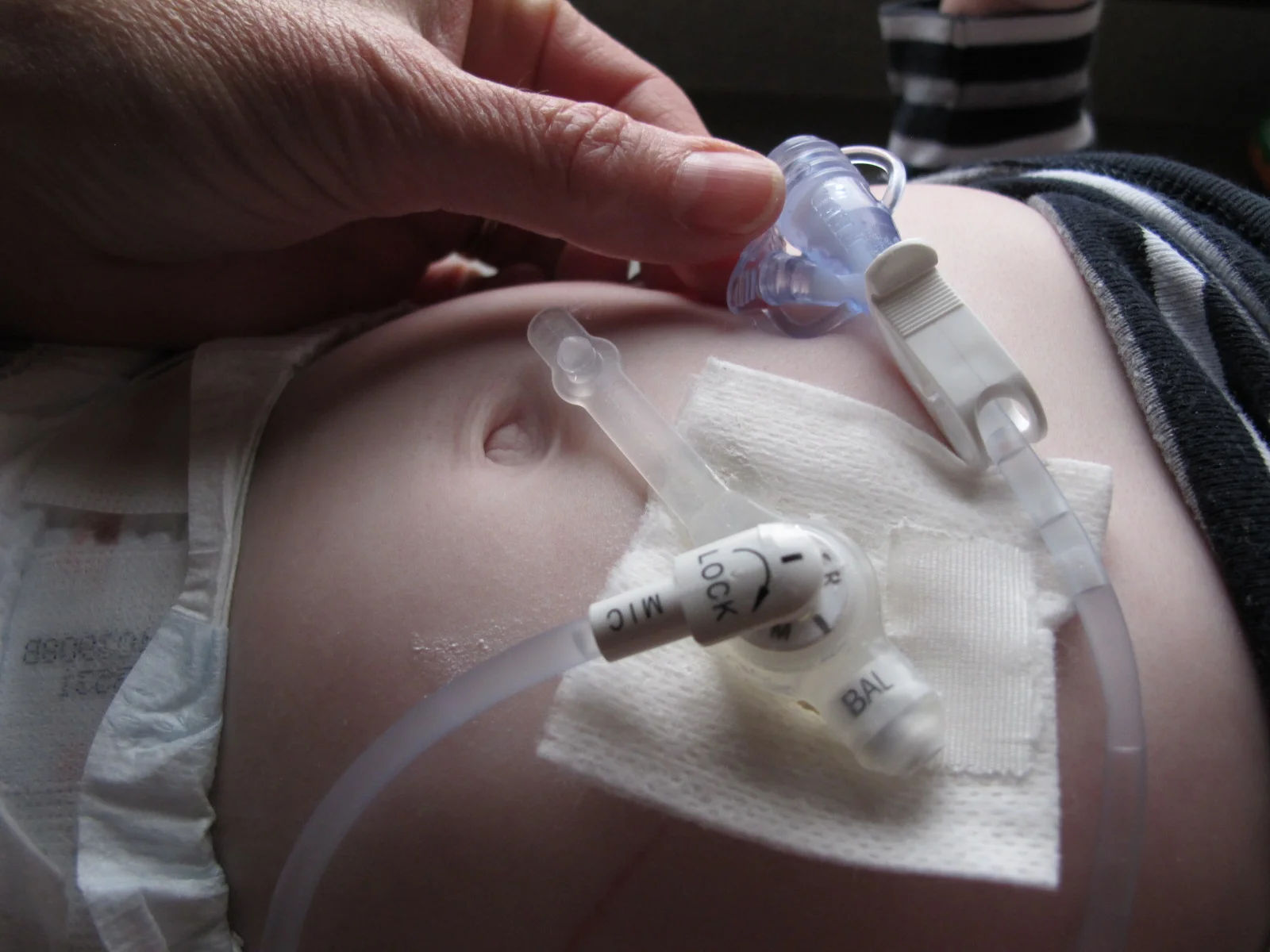 Nathaniels G-Tube System