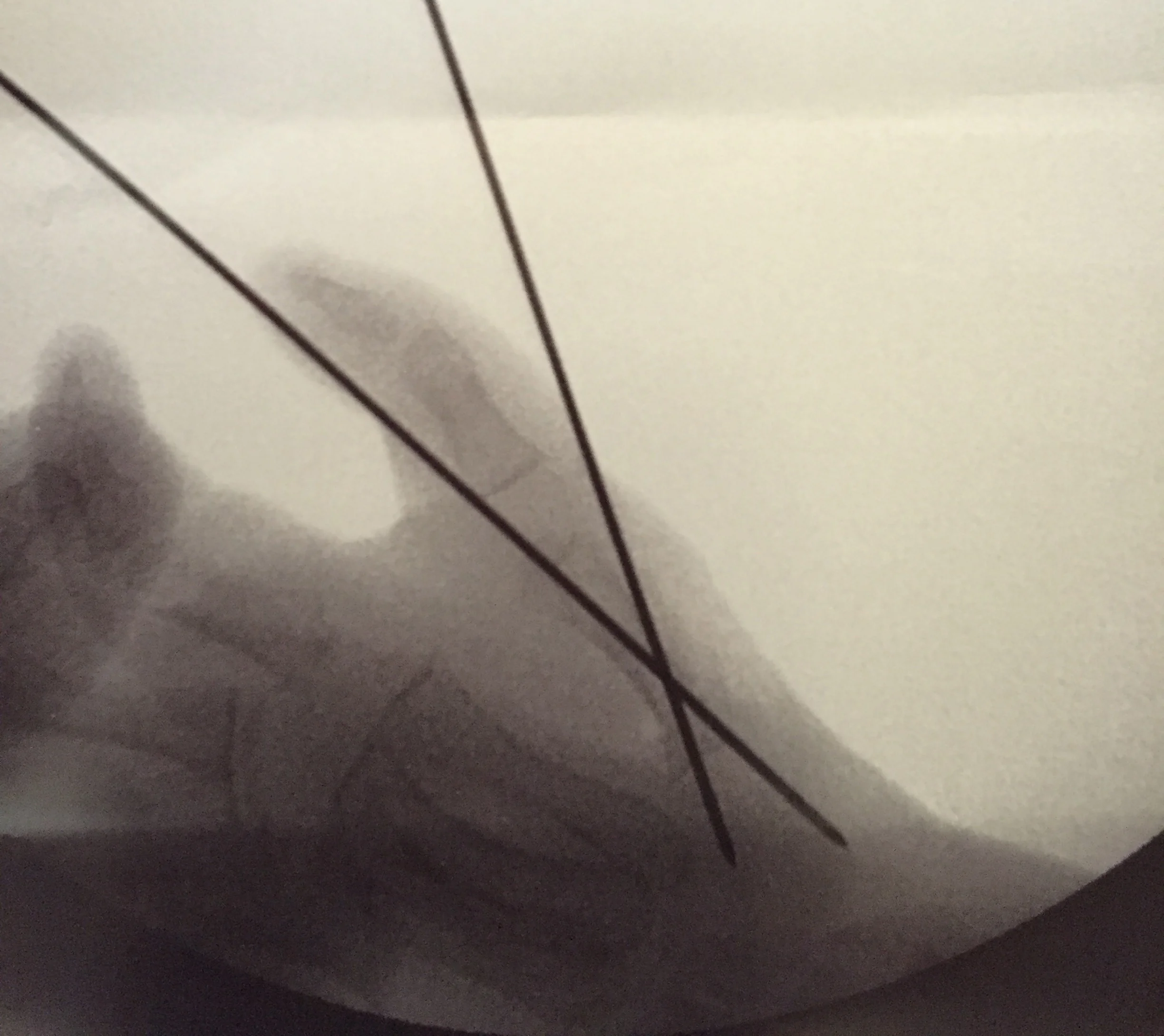 Hand Sugery and Expectations