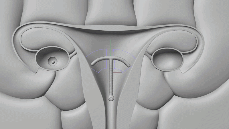 IUD_3D.gif