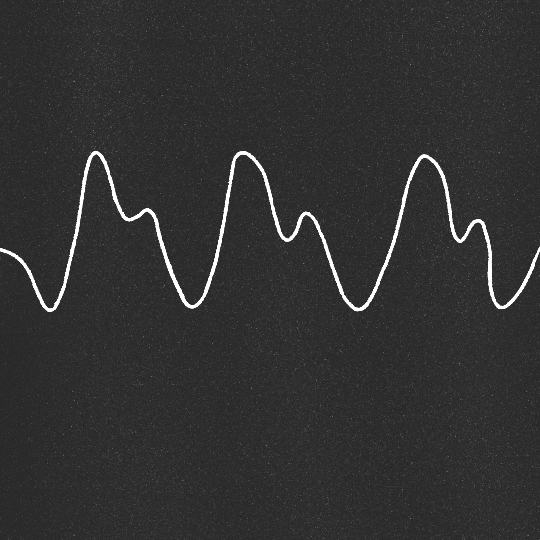 5. Sine wave pattern (leads to asystole, vfib, PEA) ~ 9 meq/L