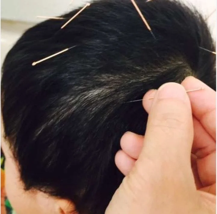 scalp acu kid.jpg