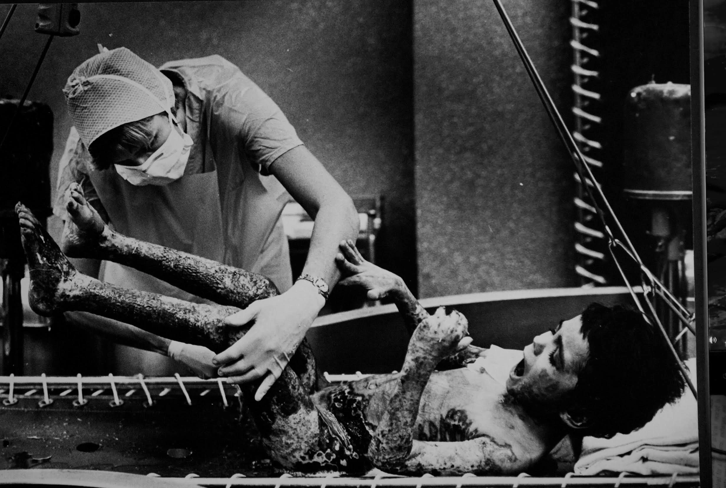 Child severely burned during Hoboken arson fires in the early 1980s. Here he is going through a daily cleaning of dead tissue at a burn center. Photograph by Bill Bayer. 