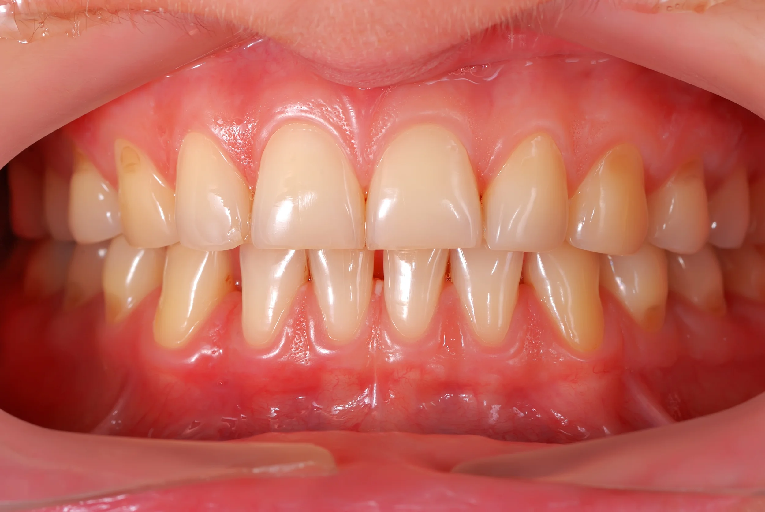 What Are The Signs And Symptoms Of Gingivitis?