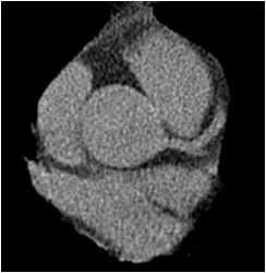 example of a normal heart calcium scan