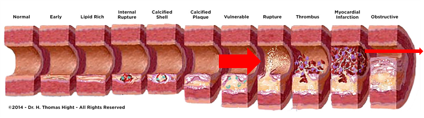 arterial plaque gets worse over time