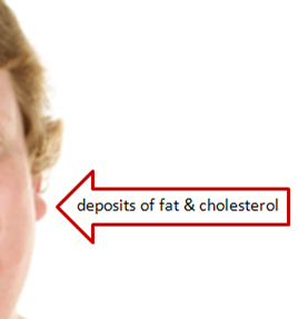 Thick ear lobes contain fat and cholesterol