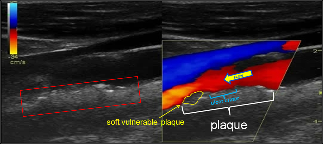 ATA US IMT plaque w flow obstruction.png