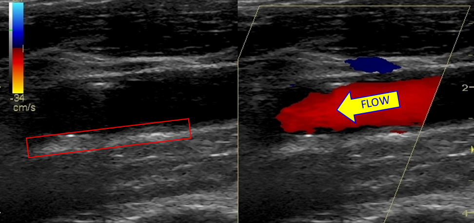 ATA US IMT plaque regression p 4 yrs.png