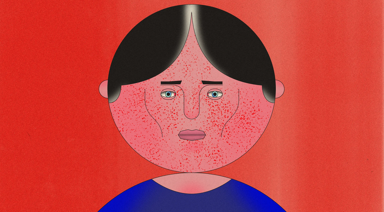GQ: How to Get Rid of Cystic Acne At the First Sign of a Pimple