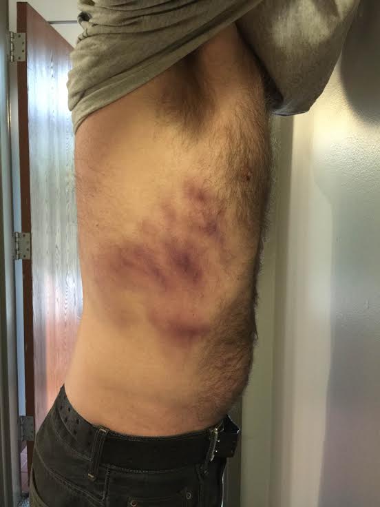 SFX Bruised