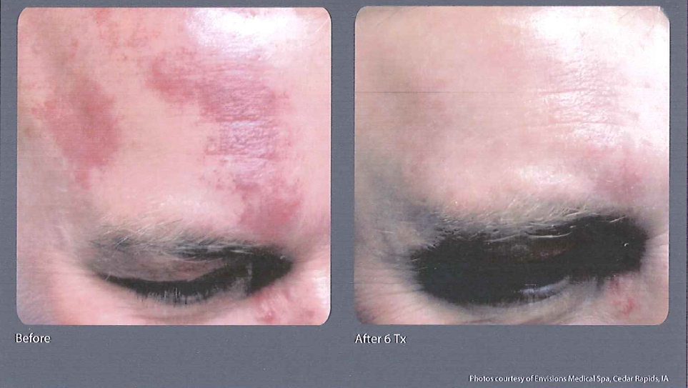 Port Wine Stain - Treated with IPL (Limelight)
