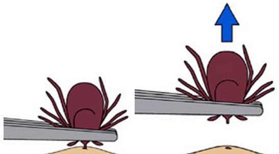 Removing a tick within 24 hours minimizes odds of infection. Grip the tick with tweezers as close to the skin as possible. Pull the tick out without twisting or crushing, and carefully check the bite site to make sure you removed the head. 