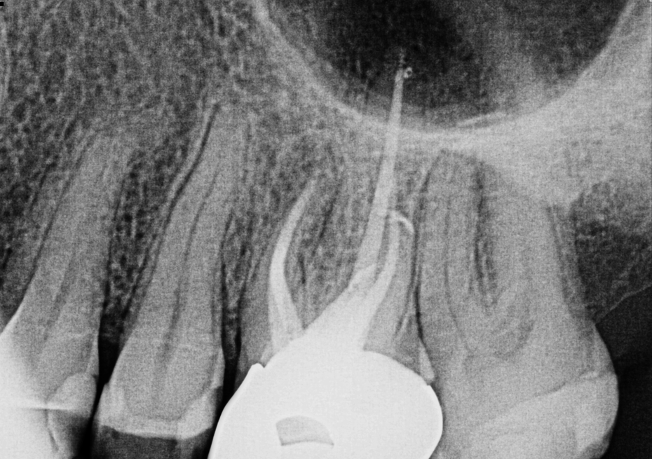 Post-op radiograph of retreatment of tooth #14