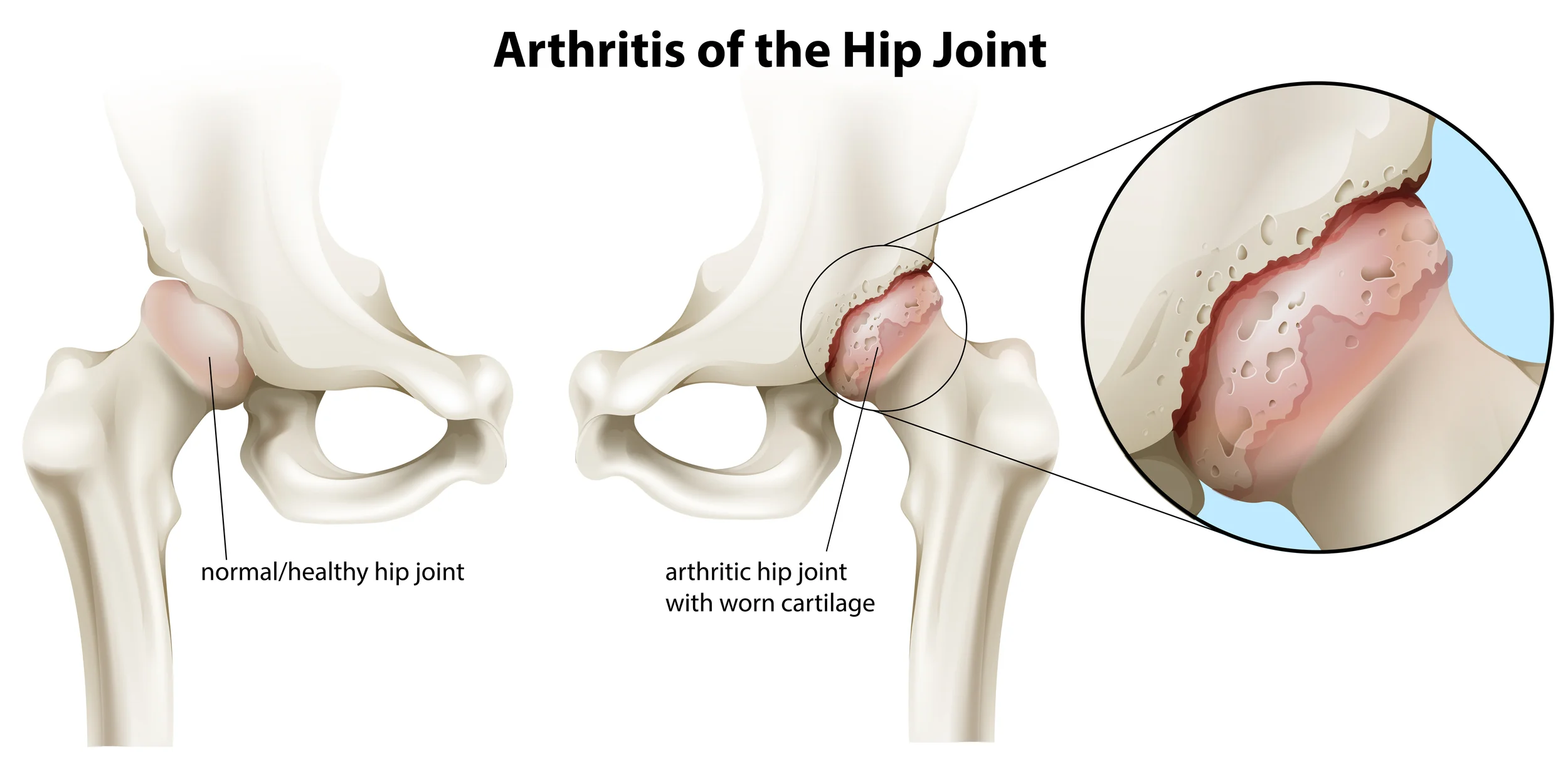 Hip Pain Treatment - Chiropractor in Nashville
