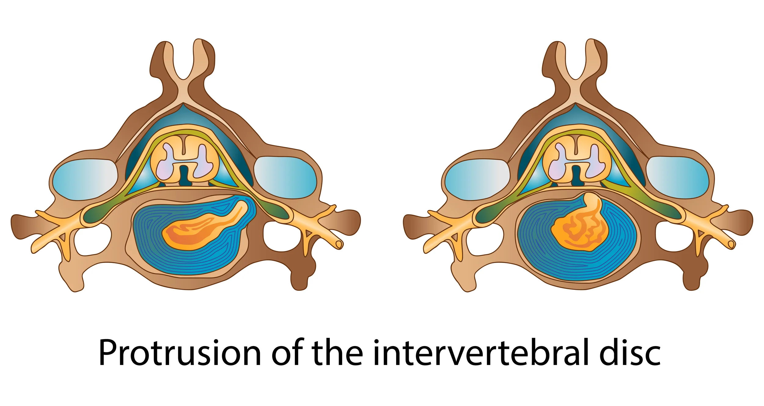 Disc Bulge, Herniation, or Rupture Pain Treatment in Nashville