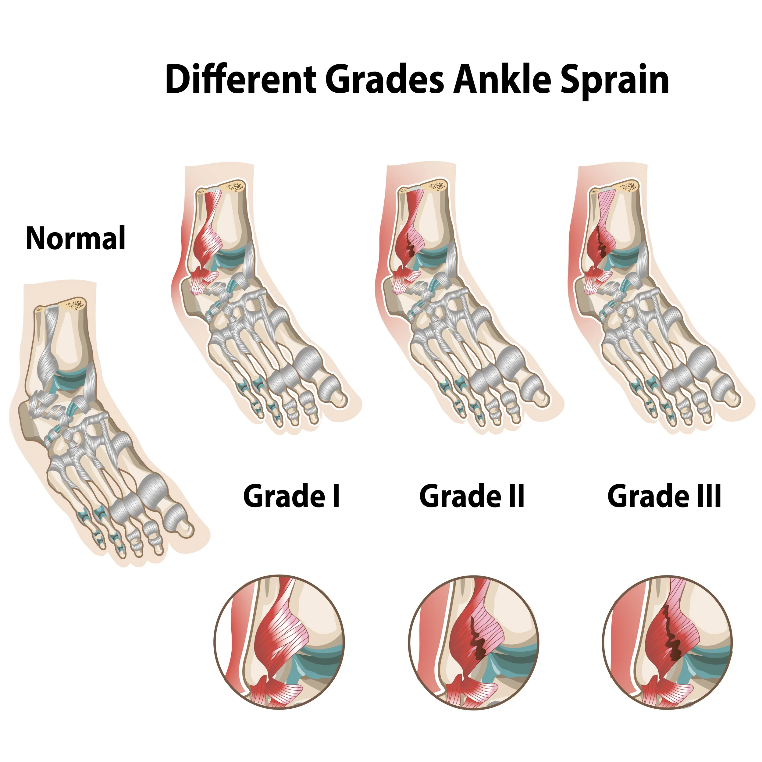 Laser Therapy for Ankle Sprain