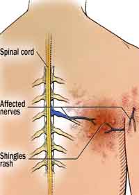 shingles on spine