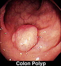 imgColonPolyps9.jpg