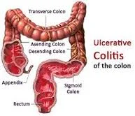ulcerative colitits.jpg