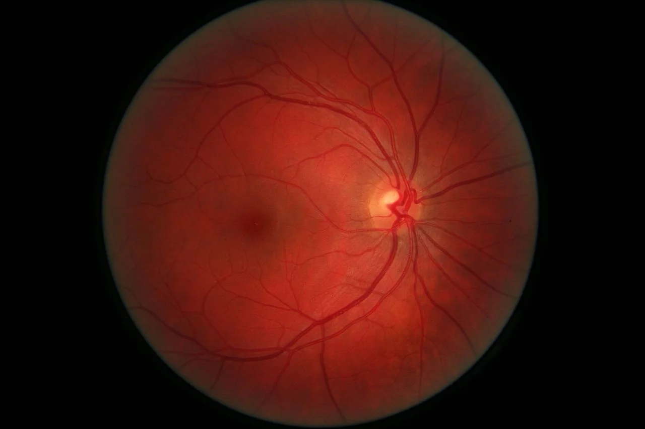 1280px-Righ_eye_retina.jpg