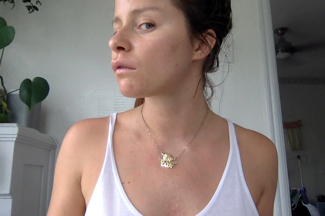 A swollen red upper lip from a really bad electrolysis session on September 4, 2017.