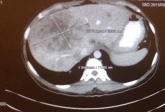 Cross-sectional image of the largest liver tumour, looking from my head towards my feet.