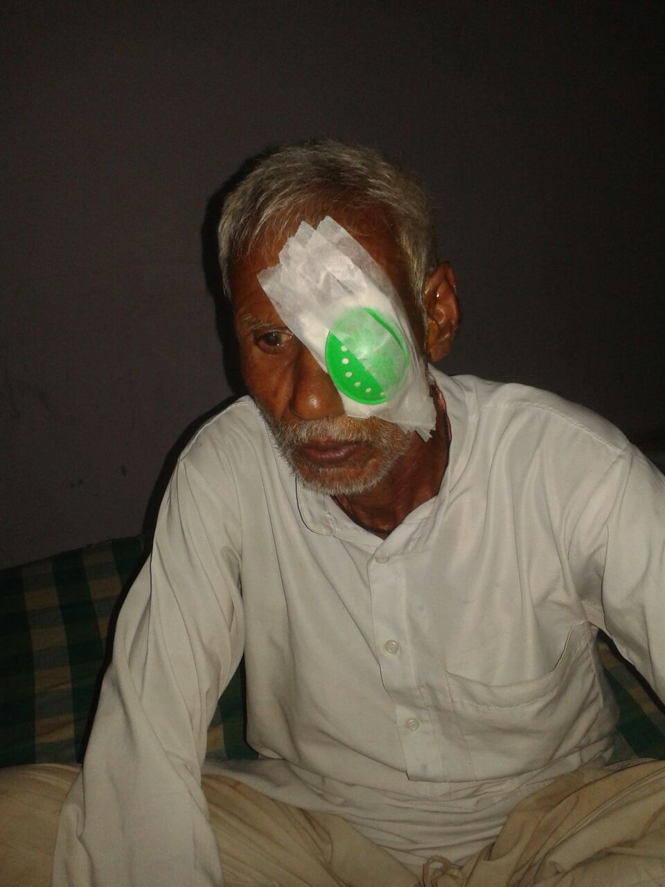 We sponsored the surgery to fix the cataract in his right eye, but Bedi has cataracts in both eyes. He is 70 years old and works as a laborer.