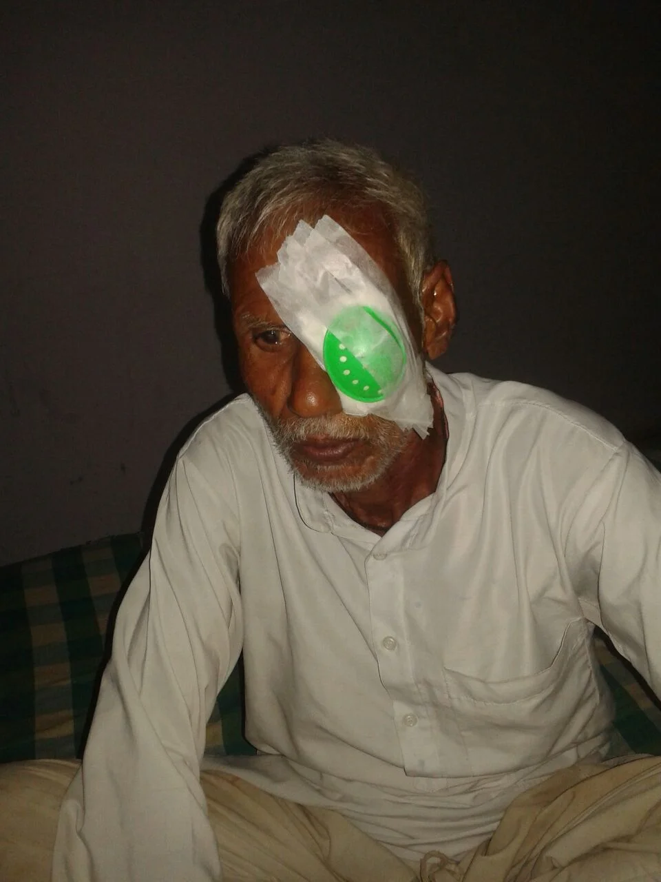 We sponsored the surgery to fix the cataract in his right eye, but Bedi has cataracts in both eyes. He is 70 years old and works as a laborer.