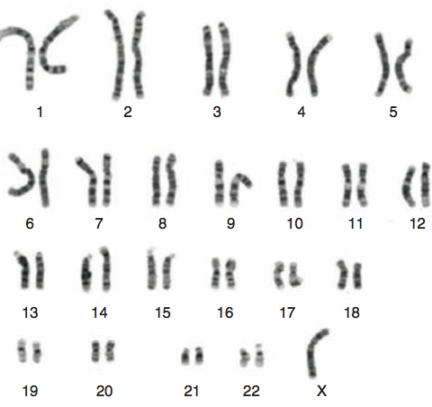 Sex chromosome analyses in Turner's Syndrome. Here the 22 pairs of autosomes are grouped according to size and the sex chromosomes placed at the end; in this case, there is only one X chromosome. From Saenger and Bondy. Turner Syndrome . In Sperling M. (ed.) Pediatric Endocrinology. Pittsburgh PA, Elsevier 2014.