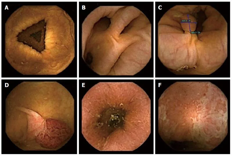 Normal colon and findings visualized at colon capsule endoscopy. A: Normal colon; B: Diverticula; C, D: Polyps; E, F: Ulcerative colitis. From Spada et al. Colon capsule endoscopy: What we know and what we would like to know. World Journal of Gastroenterology 2014: 7; 20(45): 16948-16955.