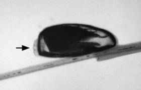 The louse nit (egg) with its adherent cylindrical sheath cemented to the hair shaft. The free distal end (arrow) would be directed towards the hair tip. The egg has a domed operculum (arrow) that contains air holes, allowing the maturing larvae to breath.From Burkhat el al. The adherent cylindrical nit structure and its chemical denaturation in vitro. Arch. Pediatric Adolescent Medicine 1988. 152; 711.