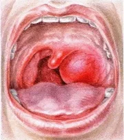 Peritonsillar abscess at the back of the mouth. But even this does not occlude the airway, and breathing is not usually affected.