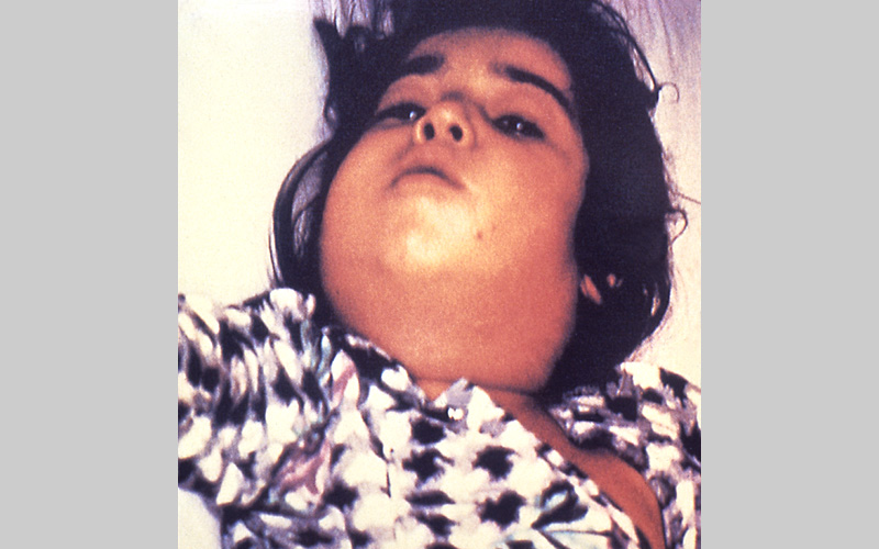 Child infected with diphtheria. Photo from the CDC .