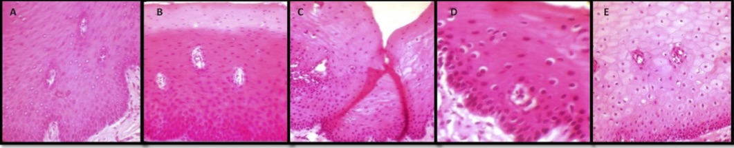 Photomicrograph of the tissues fixed in: A. Formalin, B. Honey, C. Sugar syrup, D. Molasses syrup, E. Distilled water (H & E, 40X). From Patil S, Premalatha B R, Rao R S, Ganavi B S. Revelation in the Field of Tissue Preservation – A Preliminary Study on Natural Formalin Substitutes. J Int Oral Health 2013; 5(1):31-38.