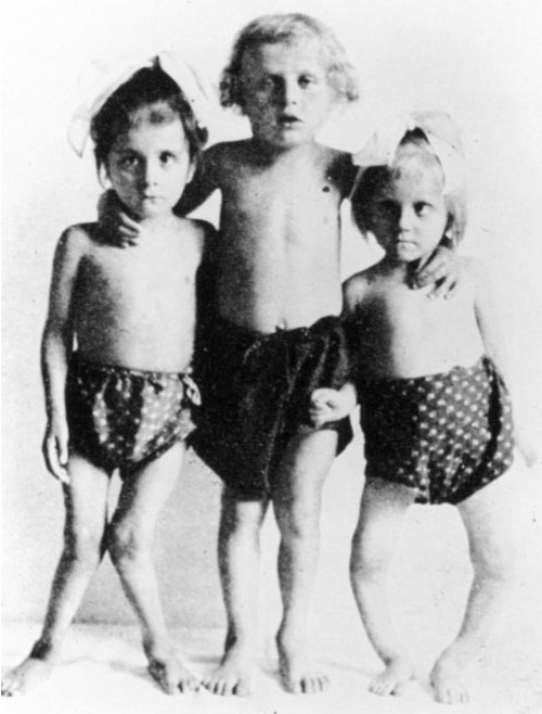 Typical presentation of 2 children with rickets. The child in the middle is normal; the children on both sides have severe muscle weakness and bone deformities, including bowed legs (right) and knock knees (left). From Holick M. Sunlight and vitamin D for bone health and prevention of autoimmune diseases, cancers, and cardiovascular disease . Am J Clin Nutr 2004;80(suppl):1678S–88S.