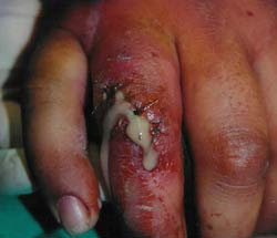 A nasty fight-bite injury, due to bacteria found in the mouth.