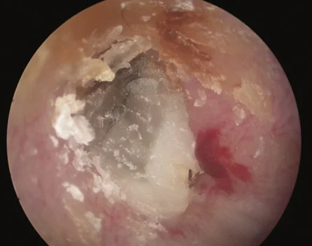 Eardrum of a patient with white candle wax causing inflammation and hearing loss.From Mohamed Zackaria & Antony Aymat (2009) Ear candling: A case report, The European Journal of General Practice , 15:3, 168-169,
