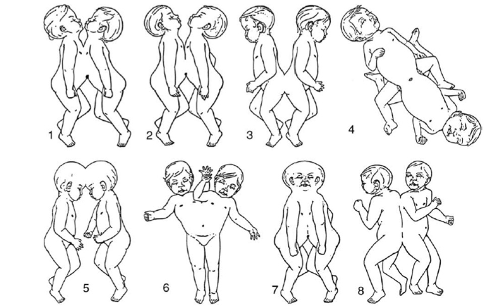One classification of conjoined twins. 1=thoracopagus, 2=omphalopagus, 3=pygopagus, 4=ischiopagus, 5=craniopagus, 6=parapagus, 7=cephalopagus, 8=rachipagus. From Pierro A. Kiley E. Spitz, L. Classification and clinical evaluation. Seminars in Pediatric Surgery 24 (2015): 207–211.