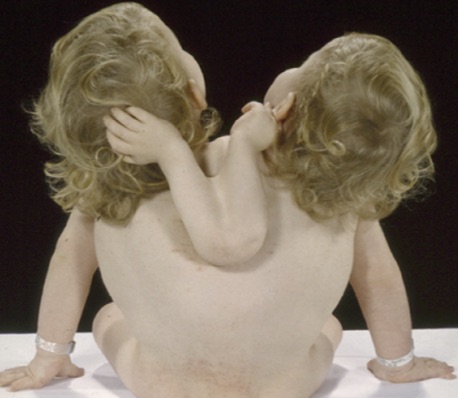 Conjoined twins Abby and Brittany Hensel the chances of survival