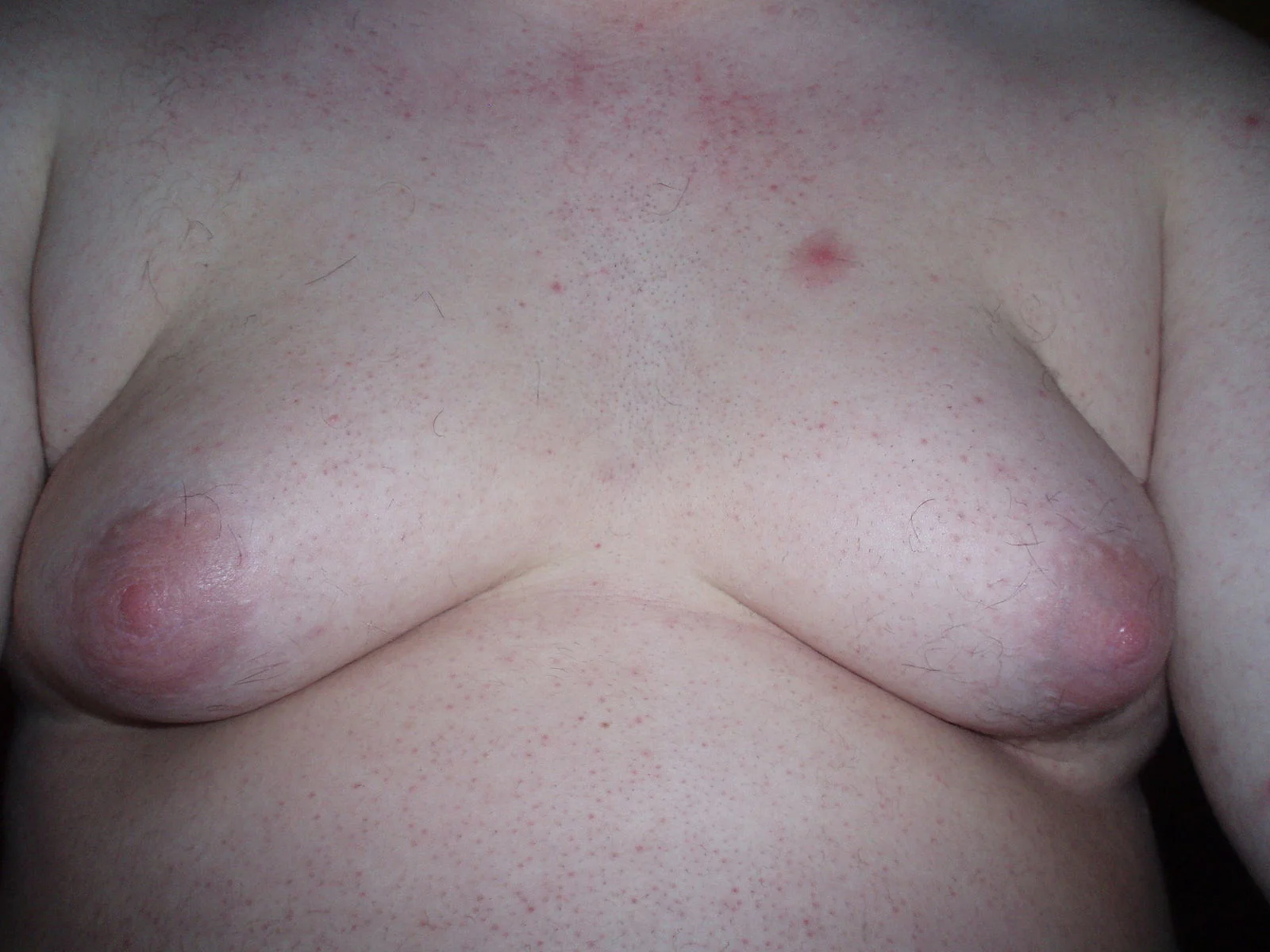 Severe gynecomastia in a young man. From here .
