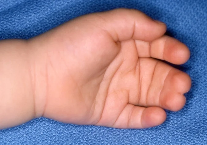 Palm view of classic simple syndactyly of left long and ring fingers. Over 50% of all webbed fingers occur like this.From here .