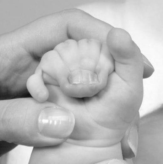 The hand of the patient with syndactyly of several digits. From Biesecker L.G. The Greig cephalopolysyndactyly syndrome. Orphanet Journal of Rare Diseases 2008, 3:10