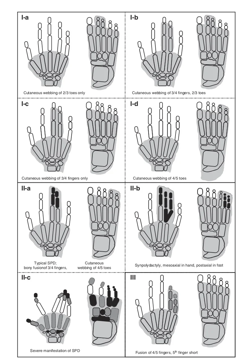Schematic diagrams of syndactyly types (I-a–III). Shaded digits depict cutaneous fusion only, while bony synostosis is represented by black digital elements within the shaded area. The grey digital elements show hypoplastic phalanges or clinodactyly/brachydactyly. The digital elements with amorphous borders symbolize dysplastic bones. From Malik S. Syndactyly: phenotypes, genetics and current classification. European Journal of Human Genetics (2012) 20, 817–824;