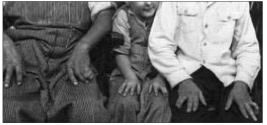 A family with three generations of ring and small finger involvement, none of which was ever surgically corrected. From Flatt A. Webbed Fingers. In The Care of Congenital Hand Anomalies, 2nd ed. St. Louis: Quality Medical Publishing, Inc., 1994:228–275.