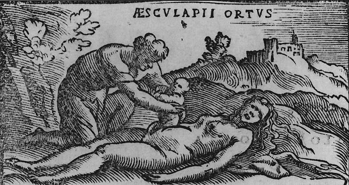 Woodcut of the post mortem cesarean birth of the Greek god Asclepius. From Alessandro Beneditti's De Re Medica published in 1549.