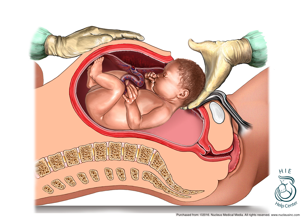 Cesarean section. From here .