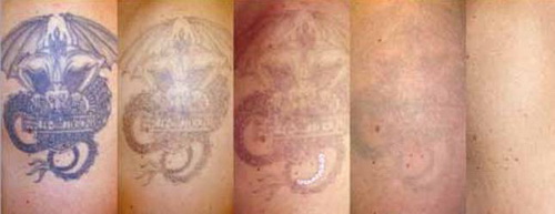 Tattoo Before After 2.jpg