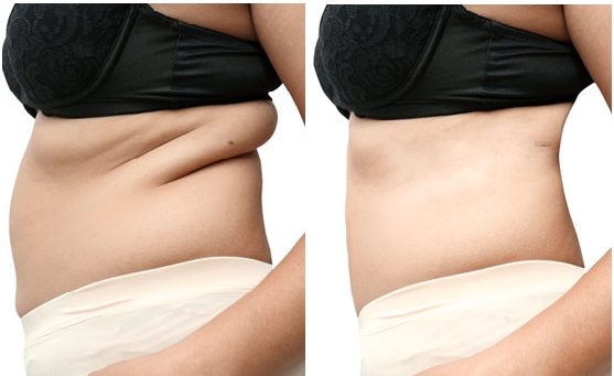 Fat Reduction.jpg